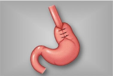 Acid Reflux Surgeon in Dallas and Plano