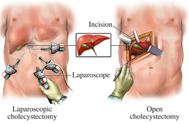 Laparoscopic Gallbladder Surgeon in Plano and Dallas