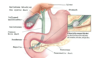 Gallbladder Removal Surgery in Dallas and Plano