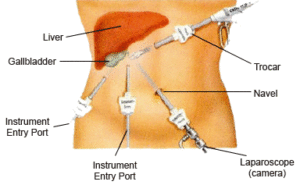 Minimally Invasive & Laparoscopic Surgery in Dallas and Plano, TX