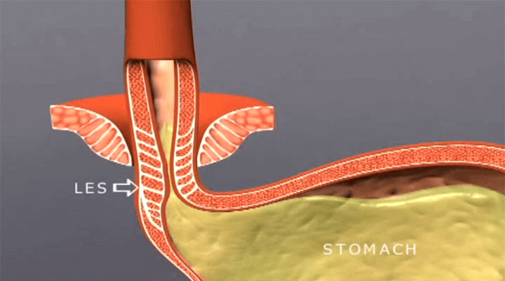 toupet fundoplication