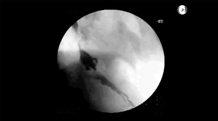 LINX System Barium Demonstration