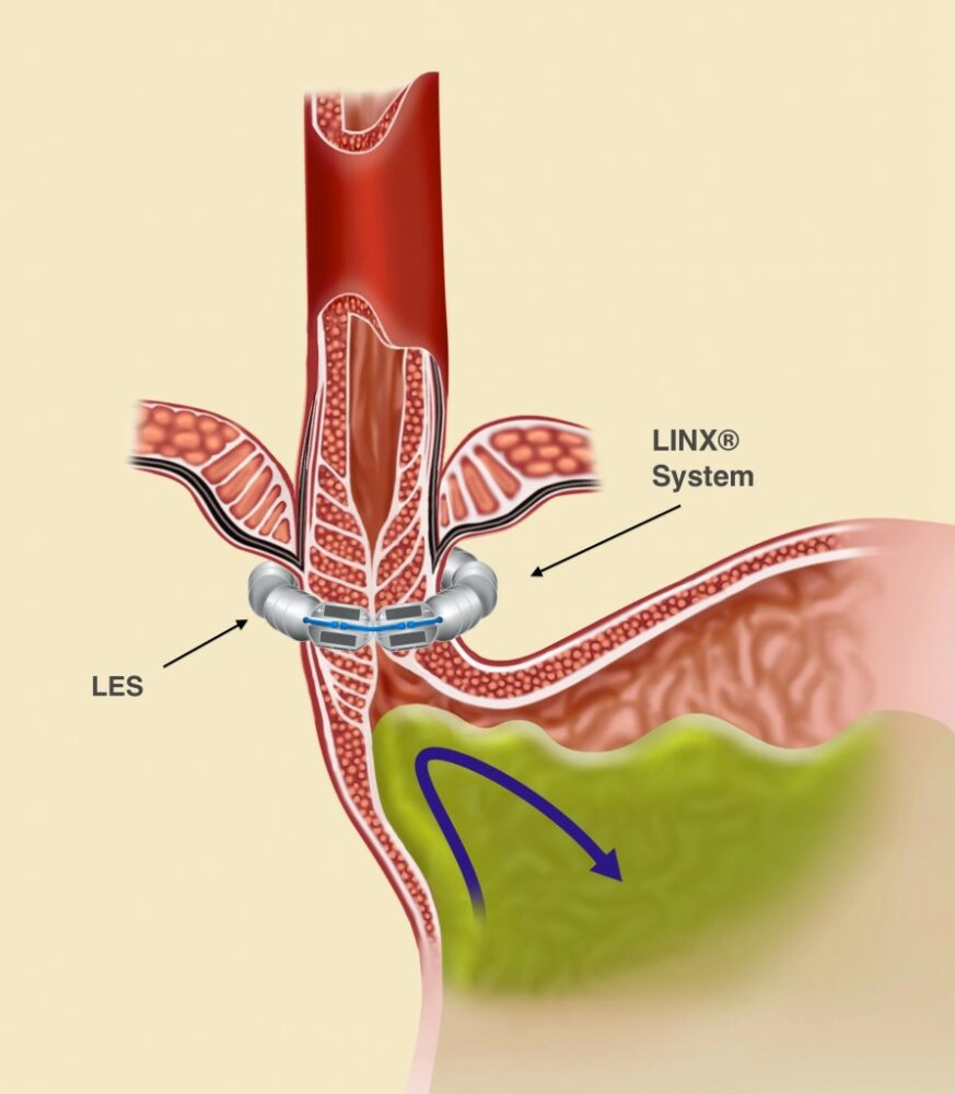 LINX® System 