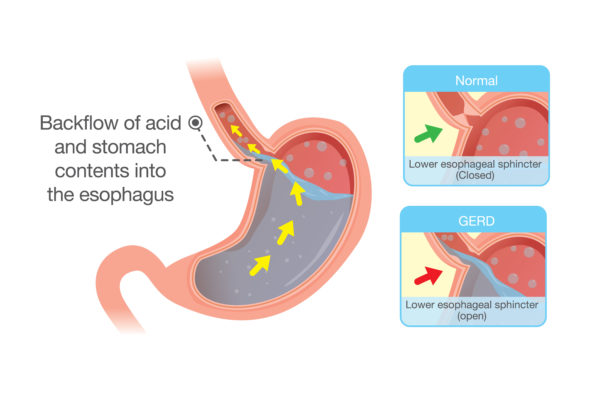 Dietary and lifestyle advice for adults with gastro-oesophageal reflux  disease (GORD) | CUH