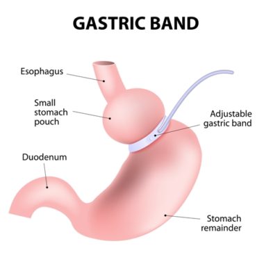 Gastric Band Adjustments