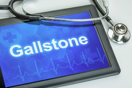 What Causes Gallstones?