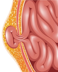 Hiatal Hernia Causes and Treatment