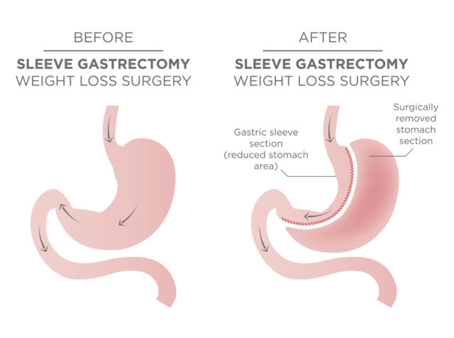 Difference between Gastric Bypass Surgery and Gastric Sleeve Surgery