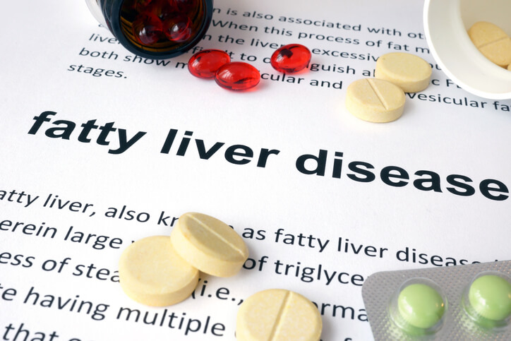 Obesity and Nonalcoholic Fatty Liver Disease