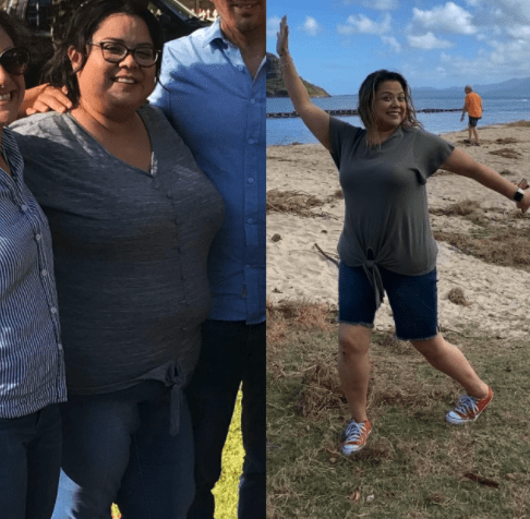 Gastric Bypass Surgery before & after