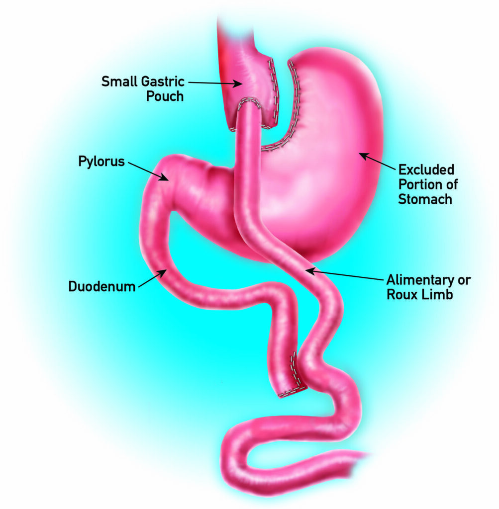 Gastric Bypass Surgery In Dallas Plano Dr Malladi bypass-gastrico