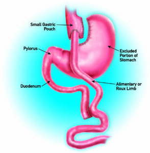 Gastric Bypass