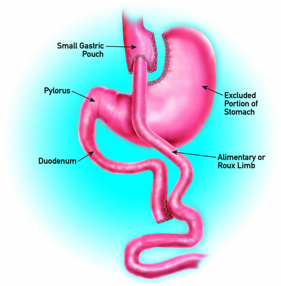 Gastric Bypass RNY Weight Loss Surgery In Dallas And Plano