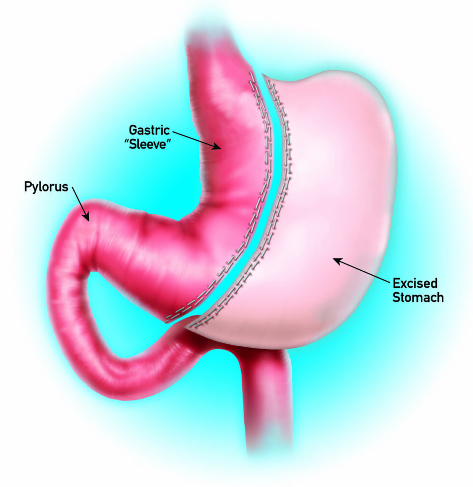 Sleeve Gastrectomy In Plano Dallas Laparoscopic Gastric Sleeve 