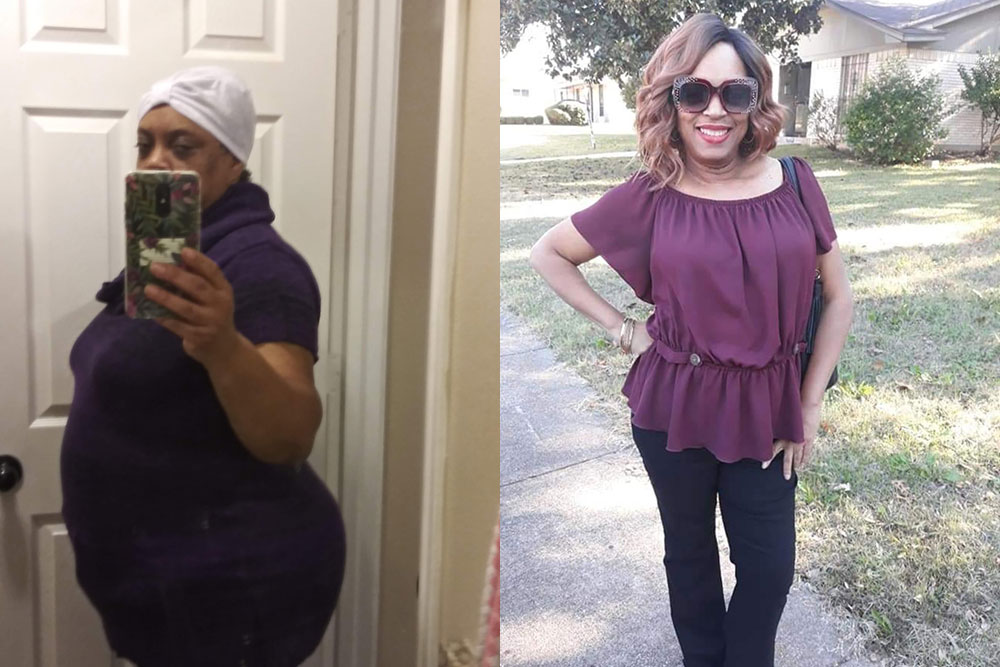 Before & After Gastric Bypass