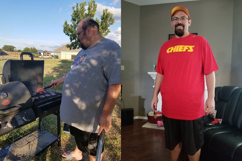 Before & After Gastric Sleeve