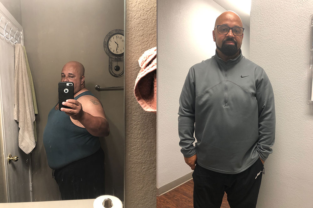 Before & After Gastric Sleeve