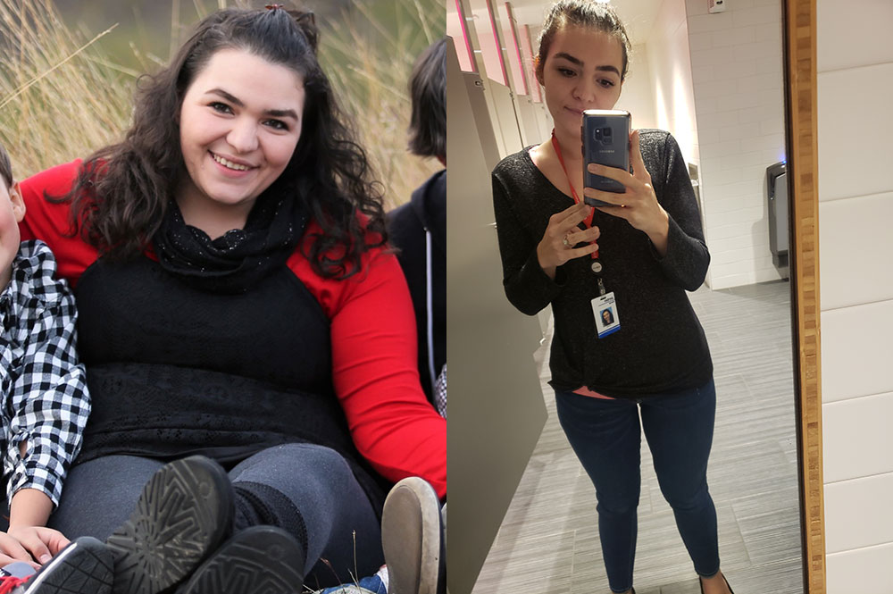 Before & After Weight Loss Surgery