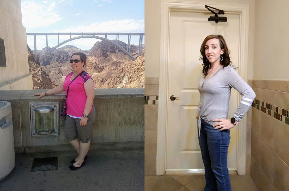 Before & After Gastric Sleeve