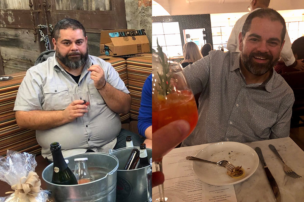 Before & After Gastric Sleeve