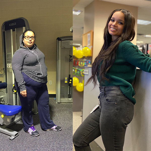 Before & After Gastric Sleeve