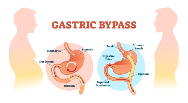 Caring for Your Stomach Pouch After Gastric Bypass