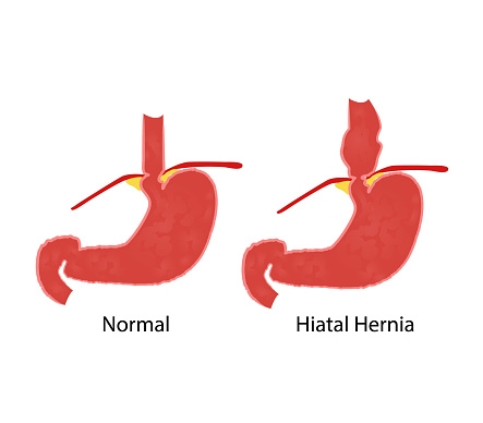 What You Need to Know About Hiatal Hernias