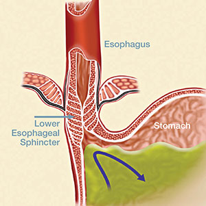 Acid Reflux Surgery Dallas