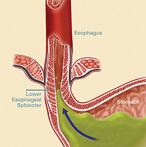 Reflux Disease Treatment