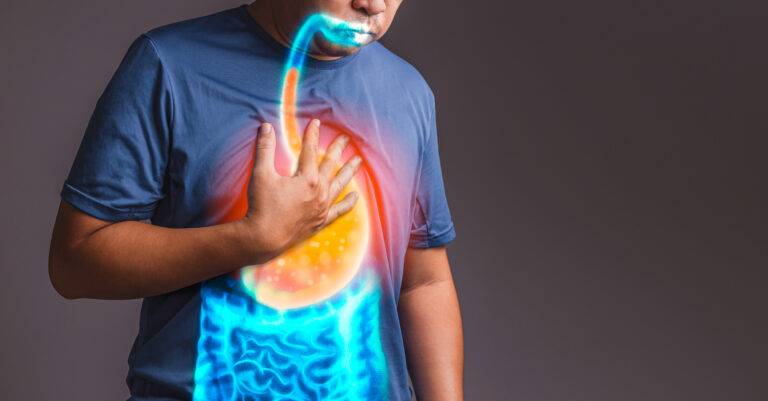 Linx treatment for GERD