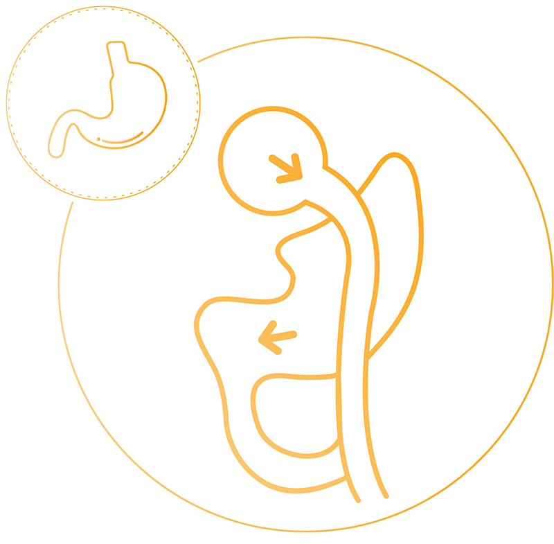 Gastric Bypass Gastric Bypass