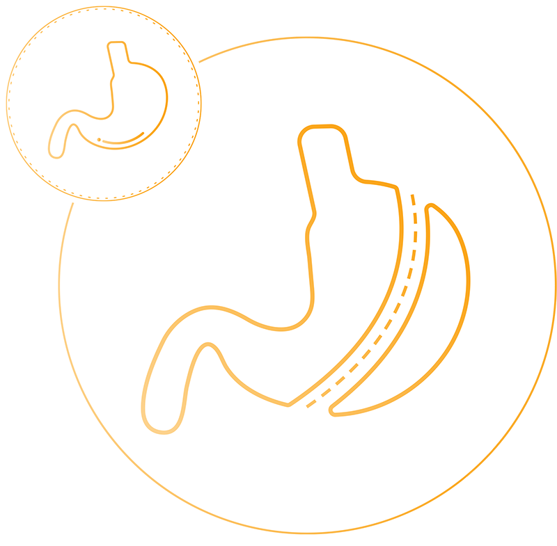 Gastric Sleeve (Sleeve Gastrectomy) Gastric Sleeve (Sleeve Gastrectomy)