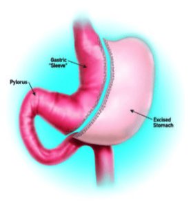 Gastric Sleeve