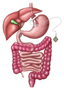 Gastric Lap Band