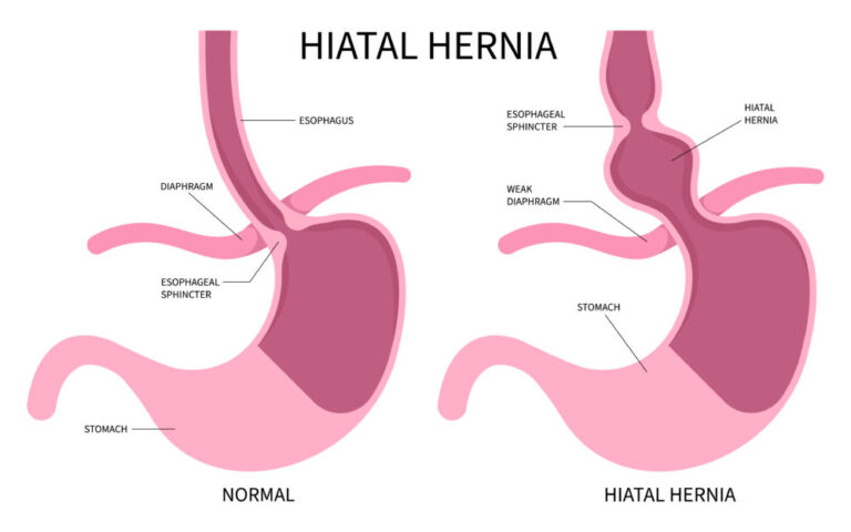 Hiatal Hernia