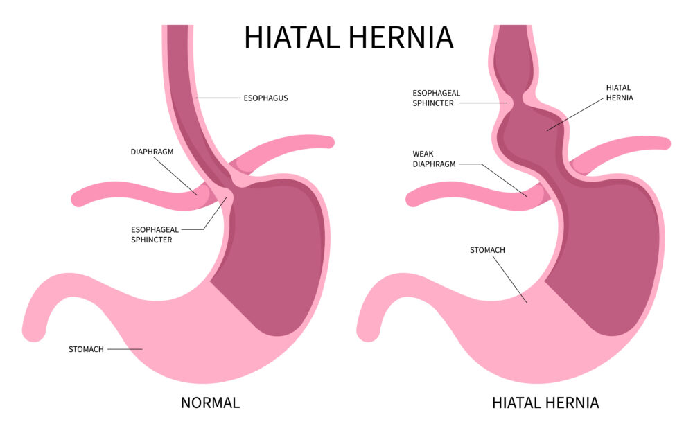 Hiatal Hernia